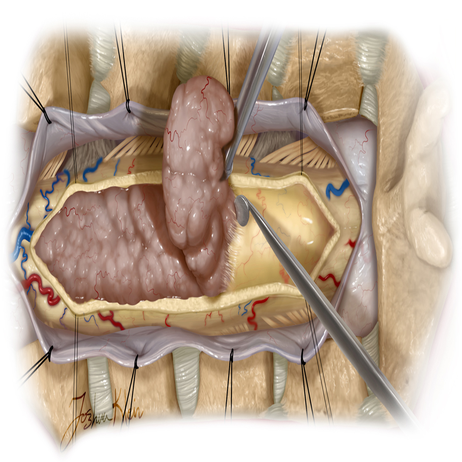 تومورهای ستون‌ فقرات در داخل کانال ستون‌ فقرات یا میان استخوان‌های آن رشد می‌کنند.