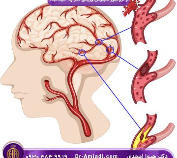 بیماری ترومبوز سینوس وریدی مغز چیست؟